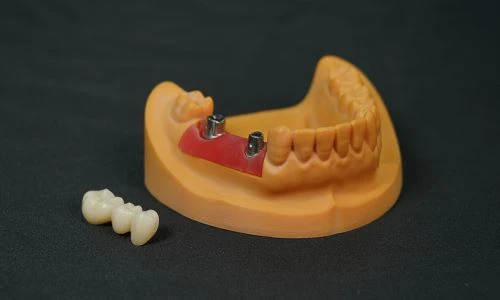 zirconia bridge Implant